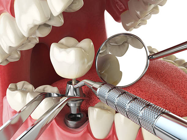 Best Emergency Tooth Extraction in Kane, PA